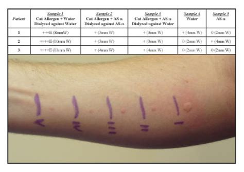 scratch test scale|how to read allergy skin test results chart.